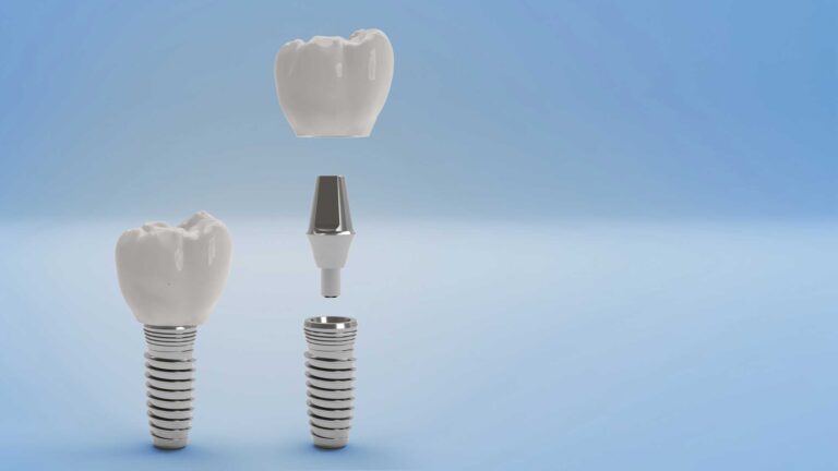 3D-rendered illustration of a dental implant showing its three main components: a titanium screw at the bottom, a metal abutment in the middle, and a white ceramic dental crown positioned above. Another fully assembled implant is displayed beside it against a light blue background