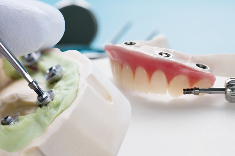 Close-up of a dental professional wearing gloves assembling a dental implant model. A metal screw is being placed into an artificial gum mold. In the background, a set of implant-supported dentures with multiple attachment points is visible, along with dental tools.