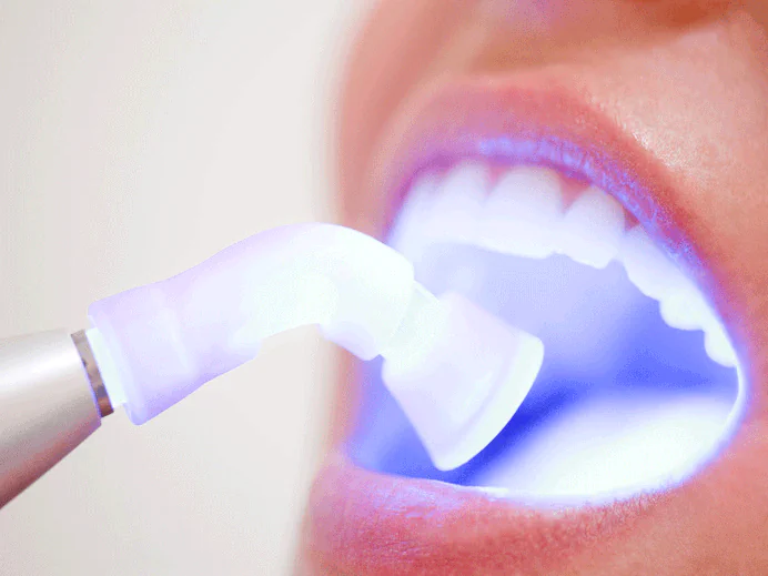 Soft-Tissue Dental Laser in Tennessee at Martin Dentistry