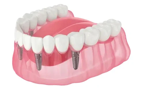 Full-Mouth Dental Implants in Tennessee at Martin Dentistry