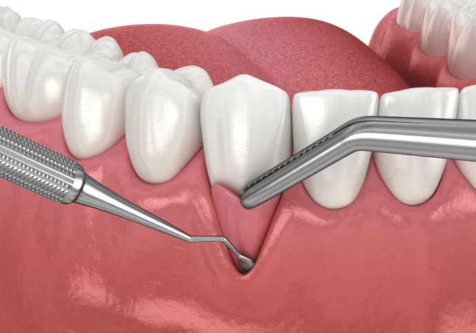 Gum Grafting in Tennessee at Martin Dentistry