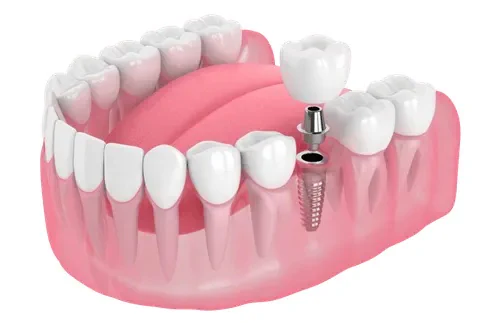 Single-Tooth Dental Implants in Tennessee at Martin Dentisty