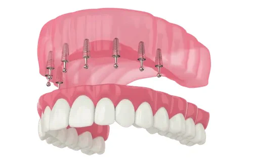 Snap-On Dental Implants in Tennessee at Martin Dentistry