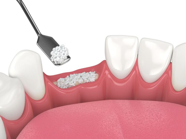3D dental illustration showing a bone graft procedure in the lower gum, with white grafting material being placed into an exposed tooth socket using a dental instrument.